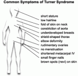 ht_turner_syndrome_common_symptoms_0803.gif