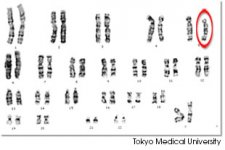 criduchat_karyotype.jpg